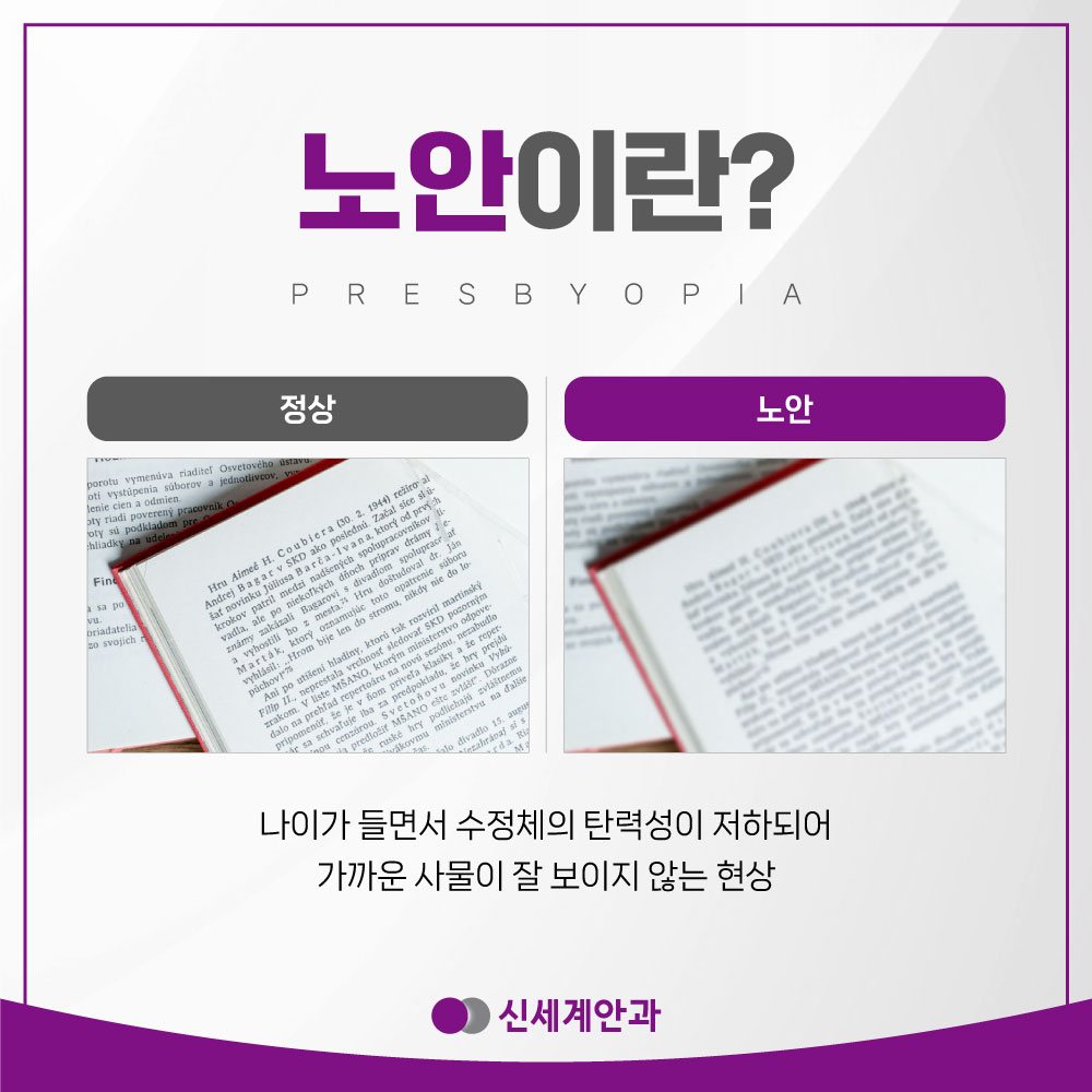 광주노안수술 광주노안수술 종류와 선택 기준은