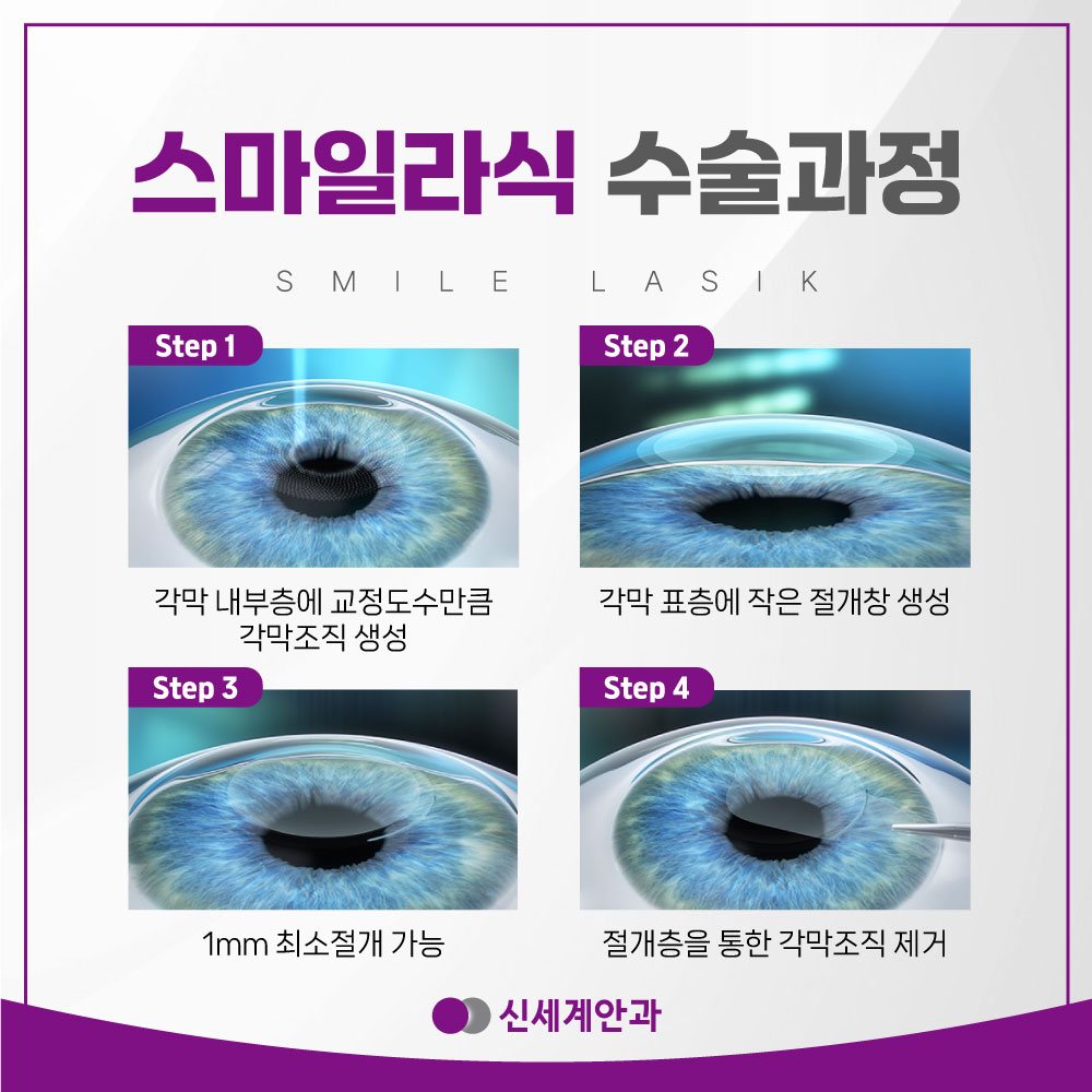 광주스마일라식 광주 스마일라식 추천 고민할 때 고려할 점은